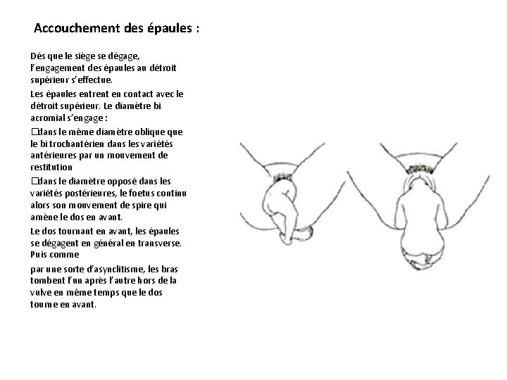 Accouchement des épaules : Dés que le siège se dégage, l’engagement des épaules au