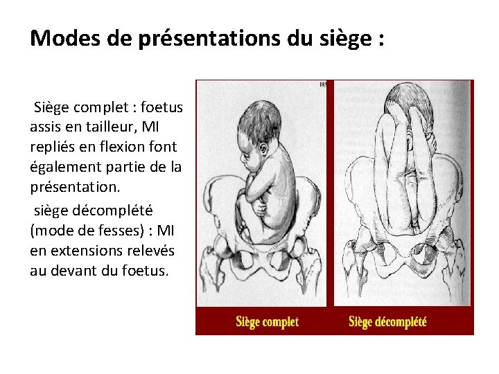 Modes de présentations du siège : Siège complet : foetus assis en tailleur, MI