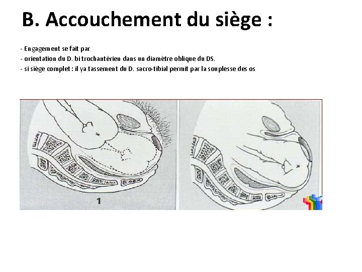 B. Accouchement du siège : - Engagement se fait par - orientation du D.