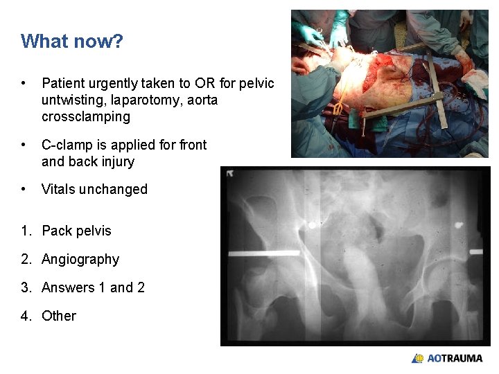 What now? • Patient urgently taken to OR for pelvic untwisting, laparotomy, aorta crossclamping