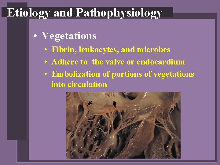 Etiology and Pathophysiology • Vegetations • Fibrin, leukocytes, and microbes • Adhere to the
