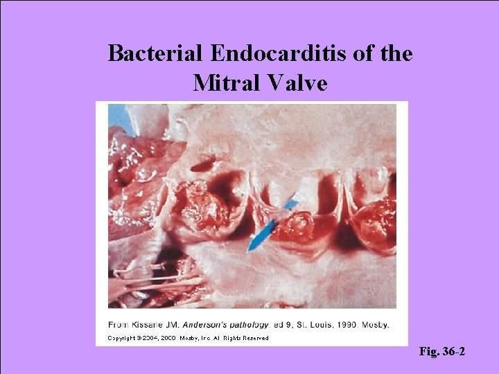 Bacterial Endocarditis of the Mitral Valve Fig. 36 -2 