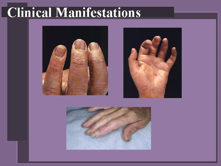 Clinical Manifestations 