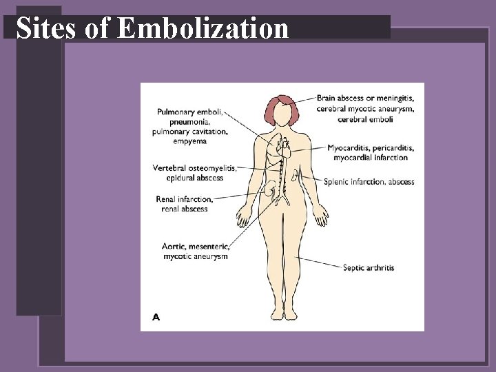 Sites of Embolization 