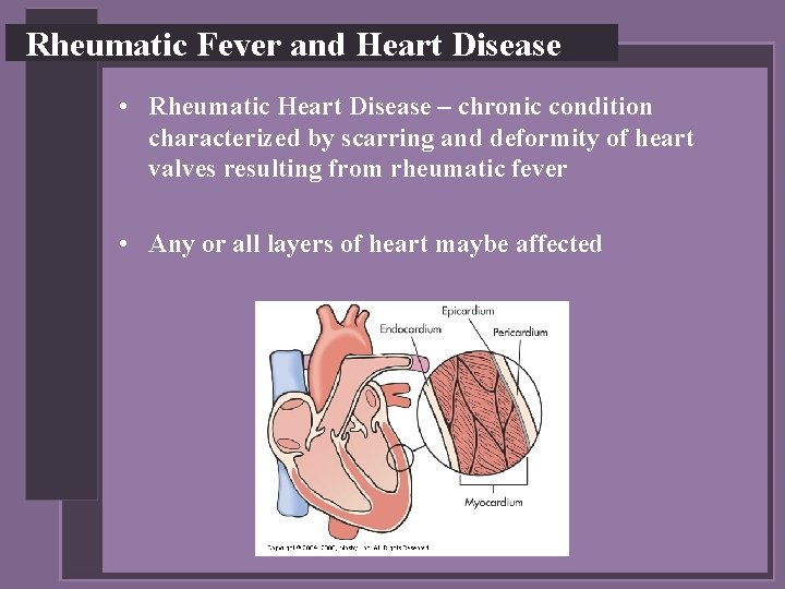 Rheumatic Fever and Heart Disease • Rheumatic Heart Disease – chronic condition characterized by