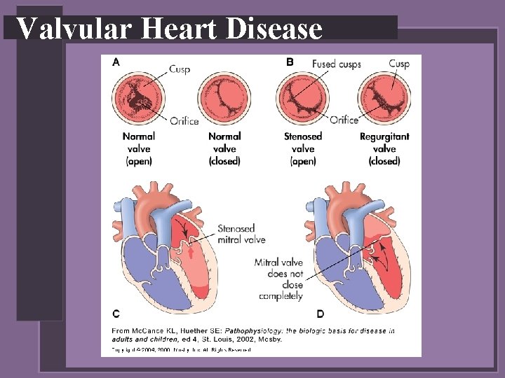 Valvular Heart Disease 