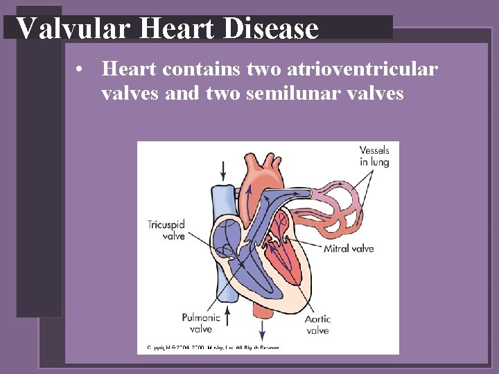 Valvular Heart Disease • Heart contains two atrioventricular valves and two semilunar valves 