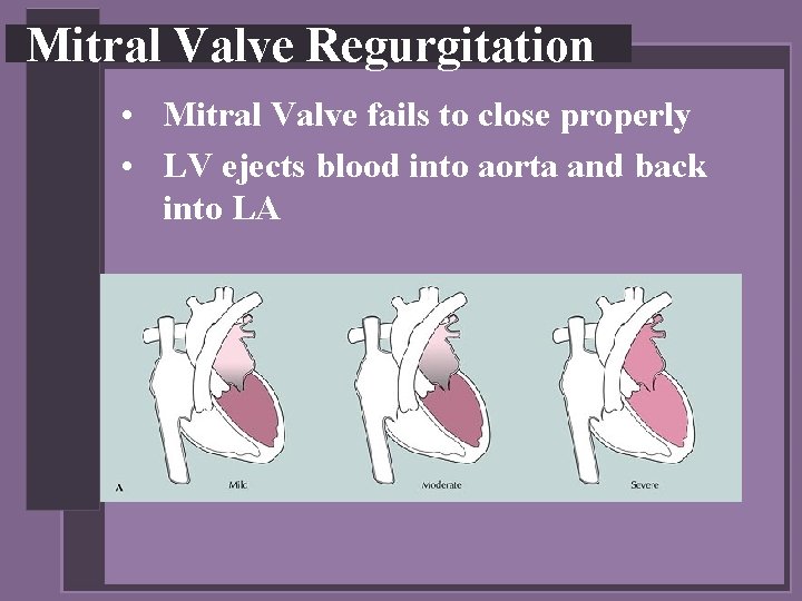 Mitral Valve Regurgitation • Mitral Valve fails to close properly • LV ejects blood