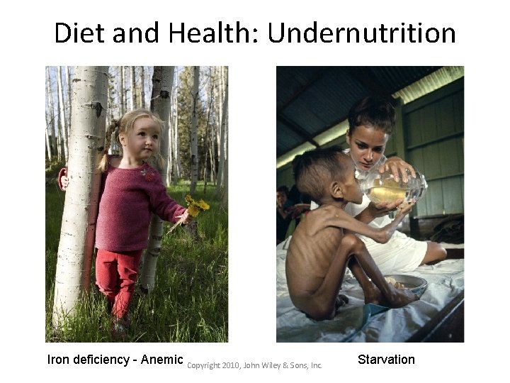 Diet and Health: Undernutrition Iron deficiency - Anemic Copyright 2010, John Wiley & Sons,