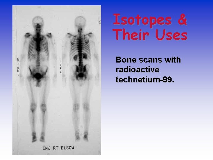 Isotopes & Their Uses Bone scans with radioactive technetium-99. 