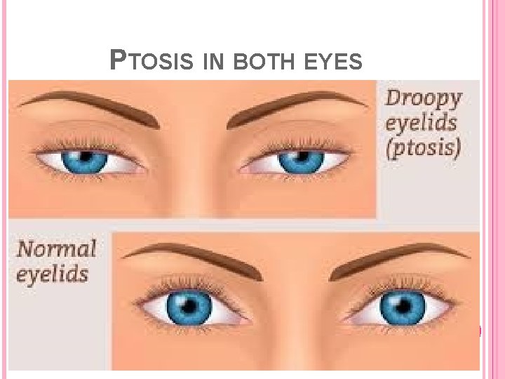 PTOSIS IN BOTH EYES 
