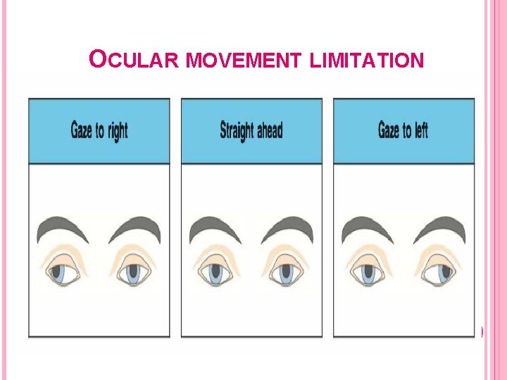 OCULAR MOVEMENT LIMITATION 