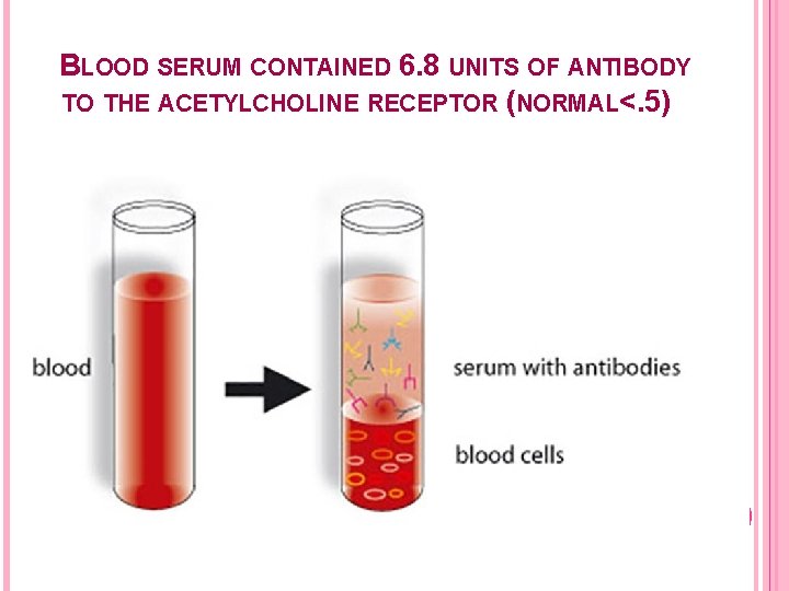 BLOOD SERUM CONTAINED 6. 8 UNITS OF ANTIBODY TO THE ACETYLCHOLINE RECEPTOR (NORMAL<. 5)