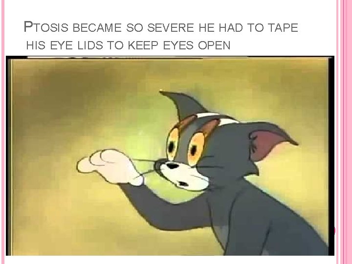 PTOSIS BECAME SO SEVERE HE HAD TO TAPE HIS EYE LIDS TO KEEP EYES