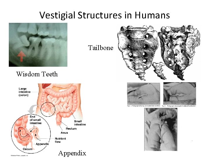 Vestigial Structures in Humans Tailbone Wisdom Teeth Appendix 