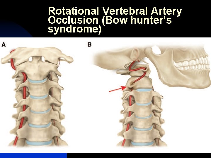 Rotational Vertebral Artery Occlusion (Bow hunter’s syndrome) 