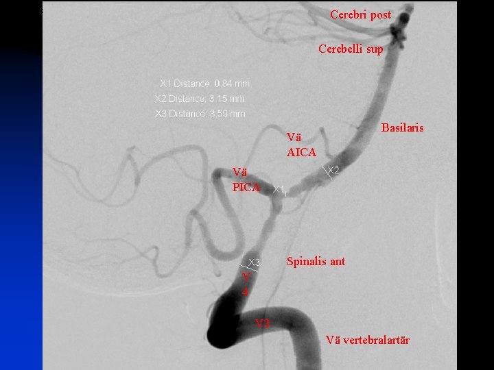 Cerebri post Cerebelli sup Basilaris Vä AICA Vä PICA Spinalis ant V 4 V