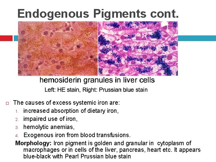 Endogenous Pigments cont. The causes of excess systemic iron are: 1. increased absorption of