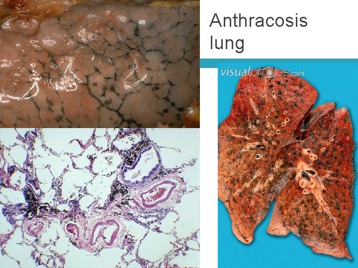 Anthracosis lung 