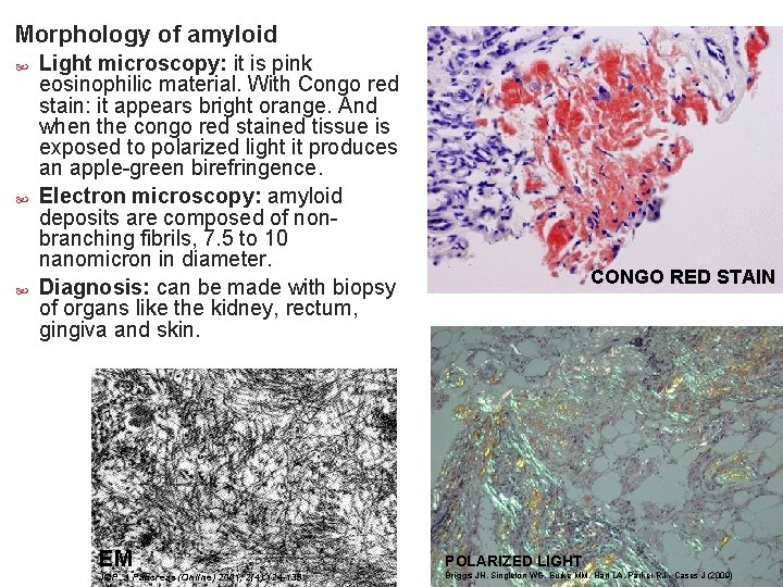 Morphology of amyloid Light microscopy: it is pink eosinophilic material. With Congo red stain: