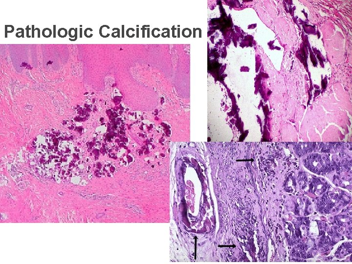 Pathologic Calcification 