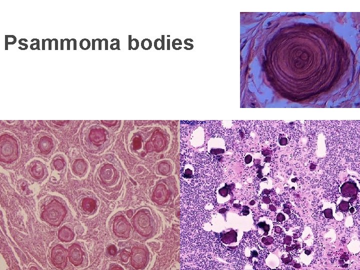 Psammoma bodies 