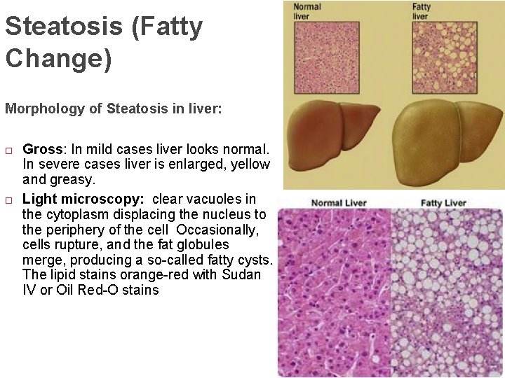 Steatosis (Fatty Change) Morphology of Steatosis in liver: Gross: In mild cases liver looks