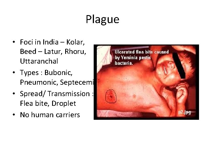 Plague • Foci in India – Kolar, Beed – Latur, Rhoru, Uttaranchal • Types
