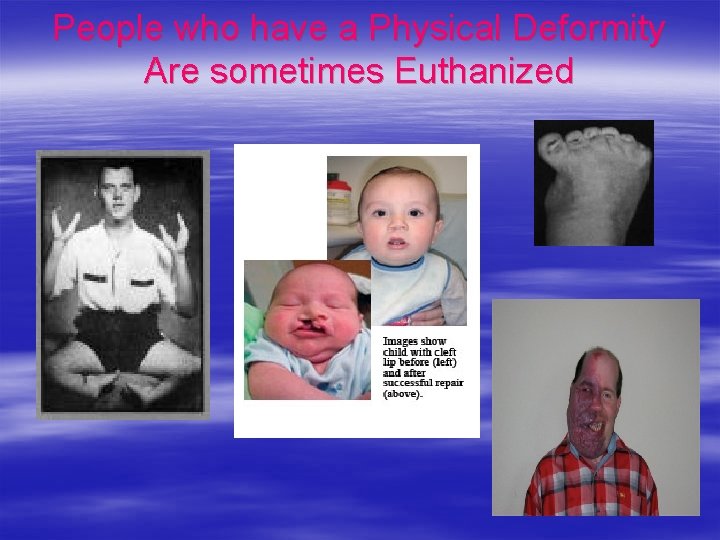 People who have a Physical Deformity Are sometimes Euthanized 