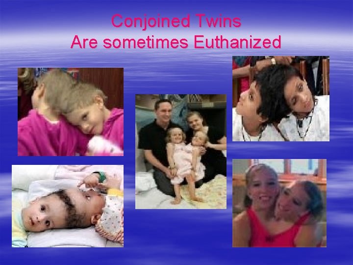 Conjoined Twins Are sometimes Euthanized 