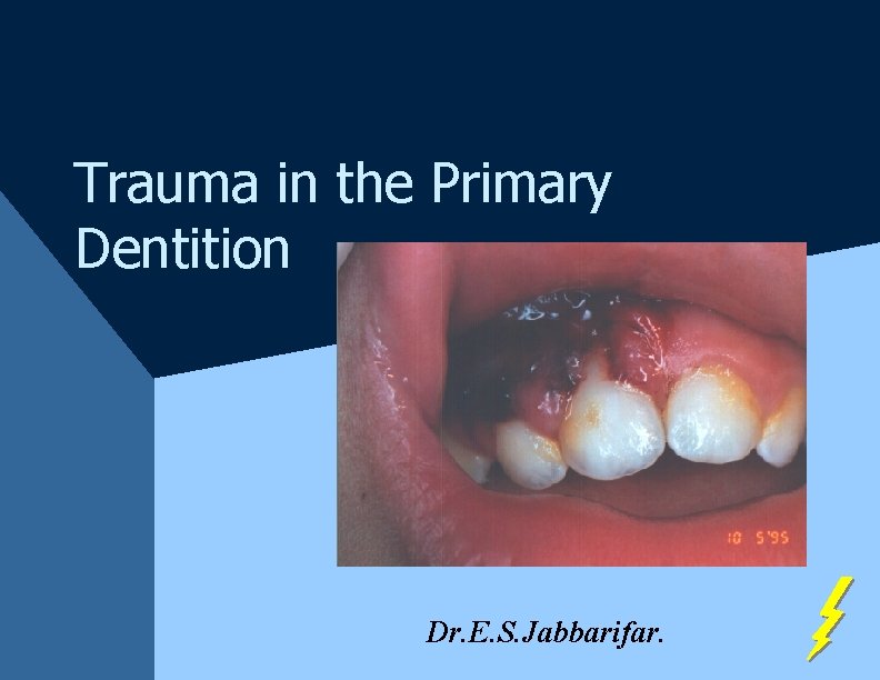 Trauma in the Primary Dentition Dr. E. S. Jabbarifar. Trauma in the Primary Dentition Dr. E. S. Jabbarifar.