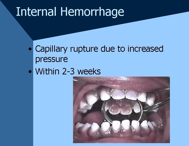 Internal Hemorrhage • Capillary rupture due to increased pressure • Within 2 -3 weeks Internal Hemorrhage • Capillary rupture due to increased pressure • Within 2 -3 weeks