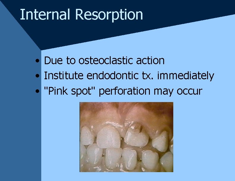 Internal Resorption • Due to osteoclastic action • Institute endodontic tx. immediately • "Pink Internal Resorption • Due to osteoclastic action • Institute endodontic tx. immediately • "Pink