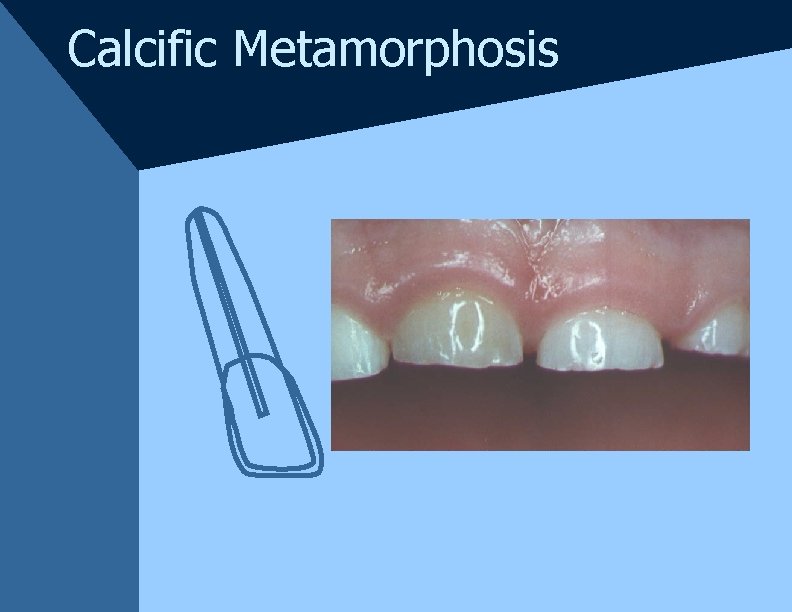 Calcific Metamorphosis Calcific Metamorphosis