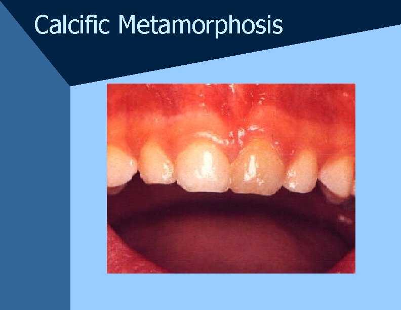 Calcific Metamorphosis Calcific Metamorphosis