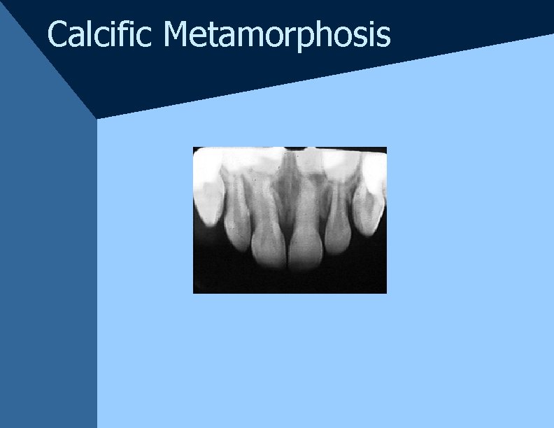 Calcific Metamorphosis Calcific Metamorphosis
