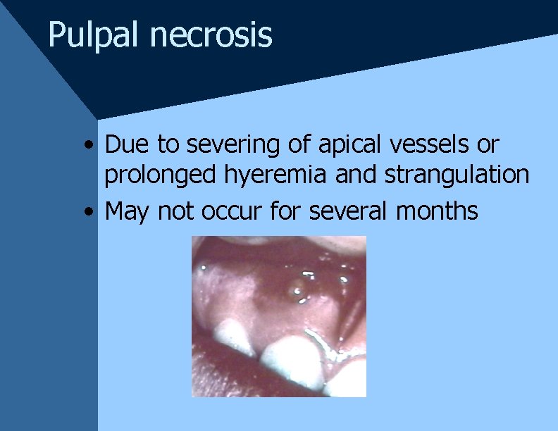 Pulpal necrosis • Due to severing of apical vessels or prolonged hyeremia and strangulation Pulpal necrosis • Due to severing of apical vessels or prolonged hyeremia and strangulation