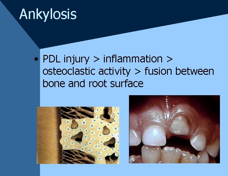 Ankylosis • PDL injury > inflammation > osteoclastic activity > fusion between bone and Ankylosis • PDL injury > inflammation > osteoclastic activity > fusion between bone and