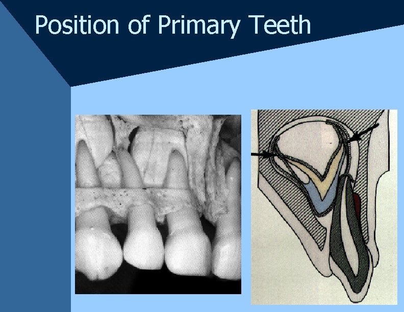 Position of Primary Teeth Position of Primary Teeth