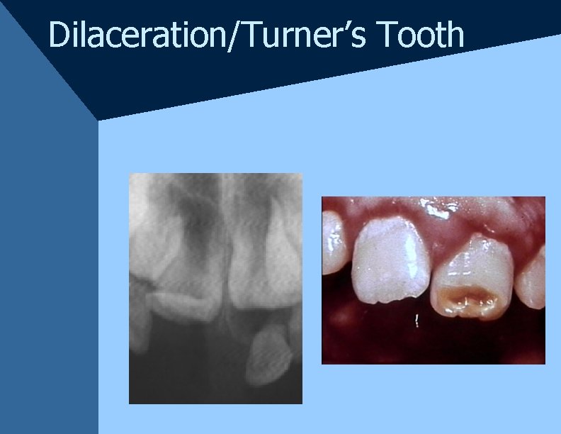 Dilaceration/Turner’s Tooth Dilaceration/Turner’s Tooth