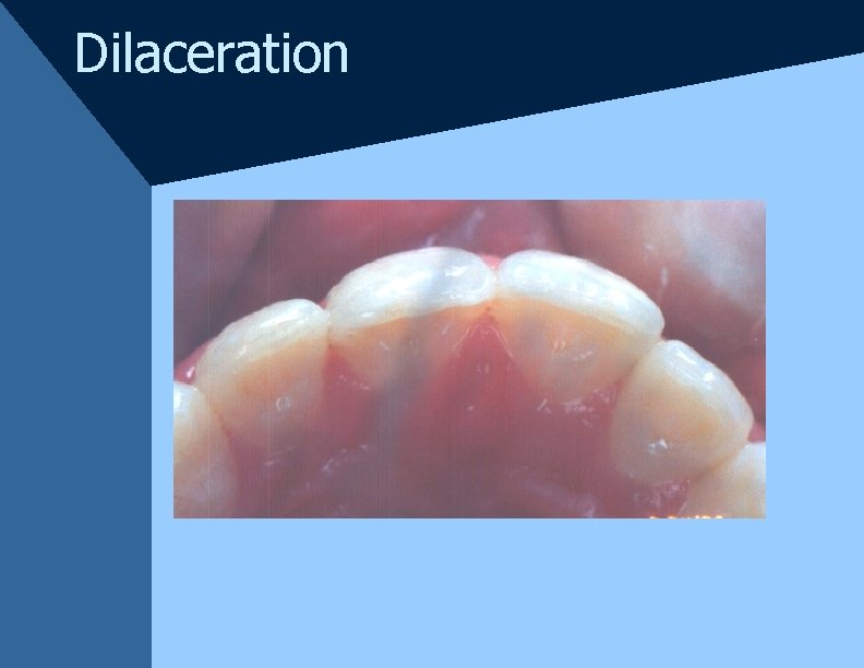Dilaceration Dilaceration