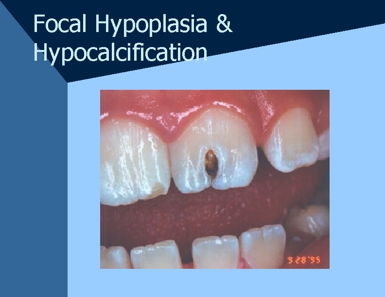Focal Hypoplasia & Hypocalcification Focal Hypoplasia & Hypocalcification