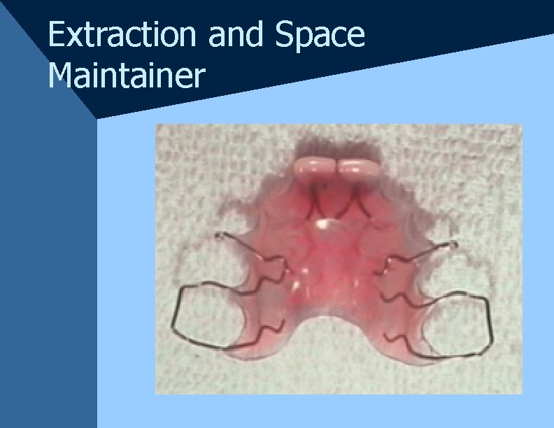 Extraction and Space Maintainer Extraction and Space Maintainer