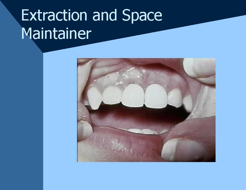 Extraction and Space Maintainer Extraction and Space Maintainer