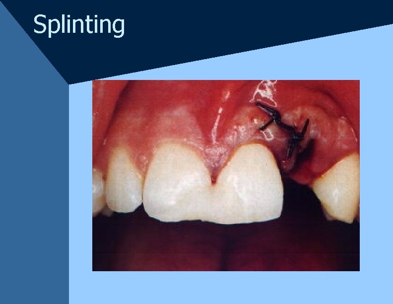 Splinting Splinting