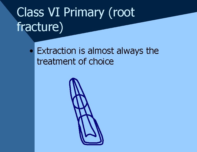 Class VI Primary (root fracture) • Extraction is almost always the treatment of choice Class VI Primary (root fracture) • Extraction is almost always the treatment of choice