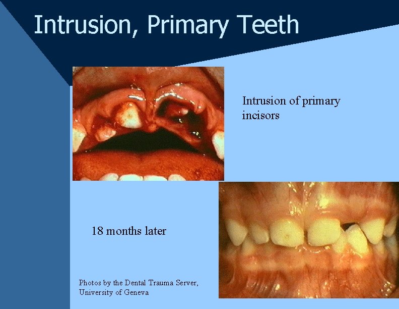 Intrusion, Primary Teeth Intrusion of primary incisors 18 months later Photos by the Dental Intrusion, Primary Teeth Intrusion of primary incisors 18 months later Photos by the Dental