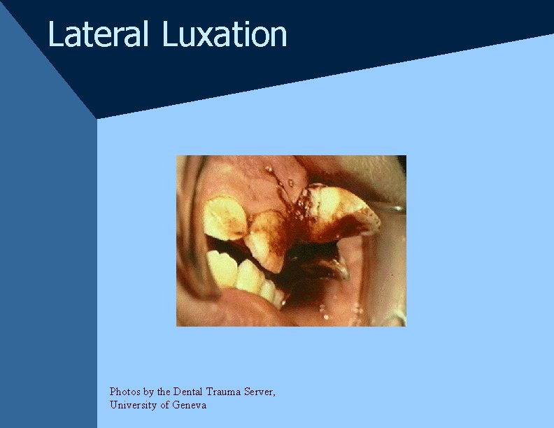 Lateral Luxation Photos by the Dental Trauma Server, University of Geneva Lateral Luxation Photos by the Dental Trauma Server, University of Geneva