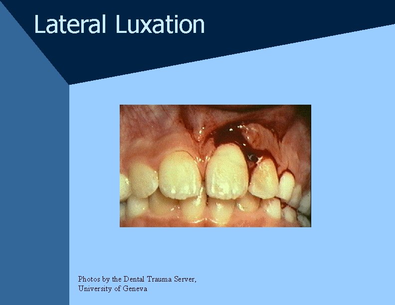 Lateral Luxation Photos by the Dental Trauma Server, University of Geneva Lateral Luxation Photos by the Dental Trauma Server, University of Geneva