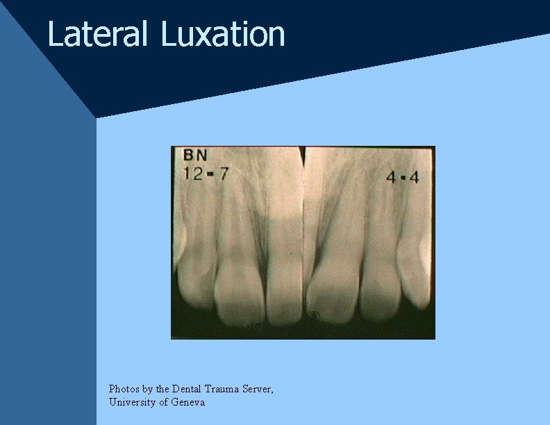 Lateral Luxation Photos by the Dental Trauma Server, University of Geneva Lateral Luxation Photos by the Dental Trauma Server, University of Geneva